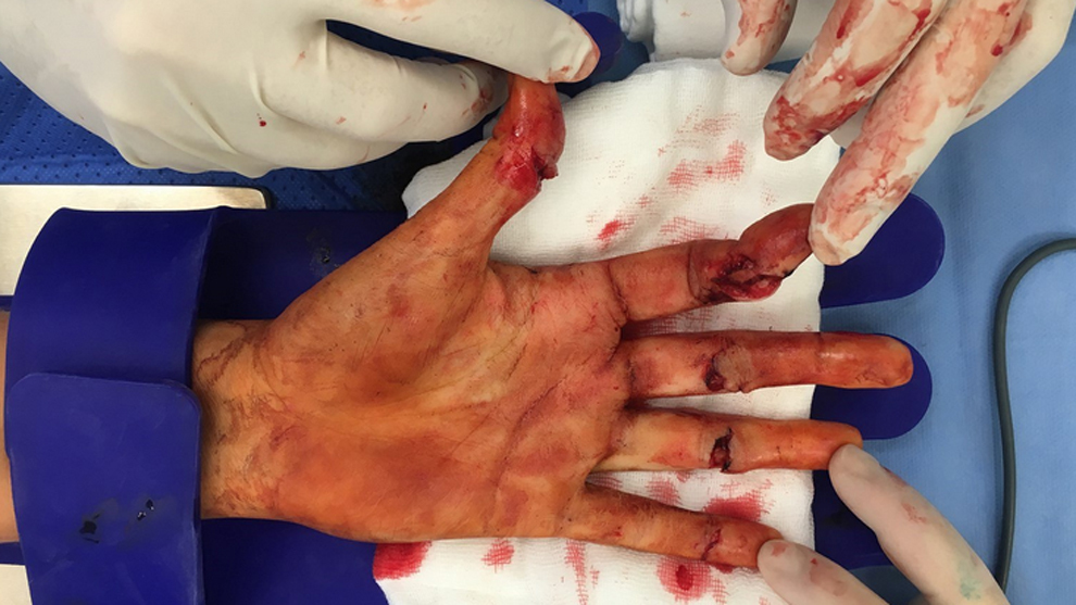 La mano herida de Petra Kvitova tras ser asaltada con un cuchillo en...