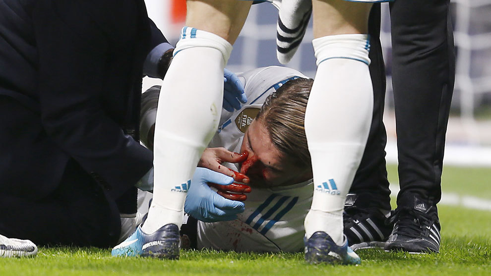 Sergio Ramos sufre una fractura en la nariz.