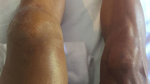 Imagen de las rodillas de Philippe Gilbert.