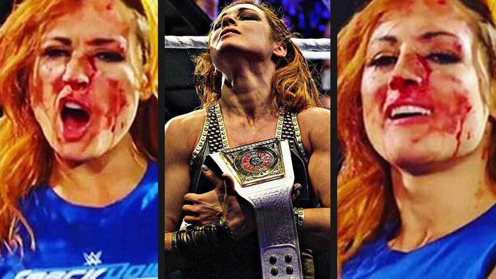Becky Lynch (Rebecca Quin), campeona del Smackdown de la WWE, sufri...