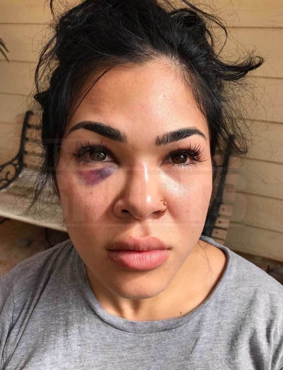 Las fotos de la luchadora Rachael Ostovich tras ser agredida por su...