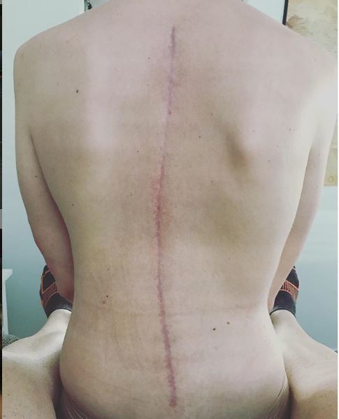 Cicatriz dejada por la operación de columna a la que se sometió la...