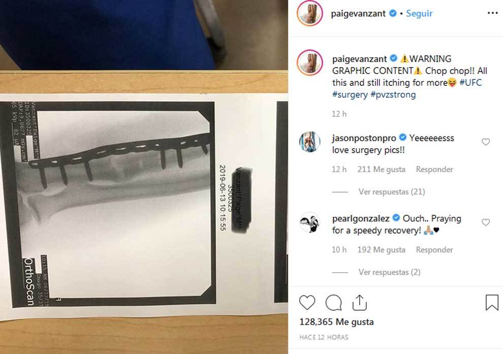 Paige VanZant shows all the details of her latest arm operation