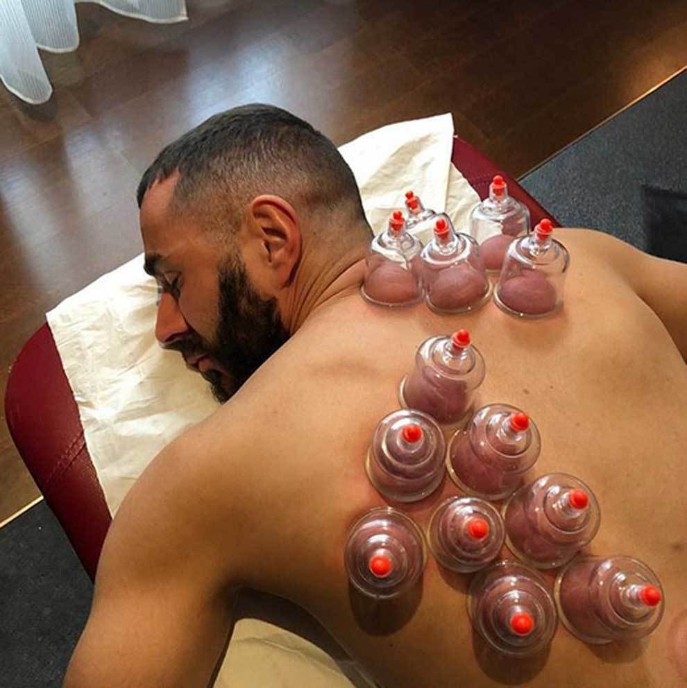 Karim Benzema sometindose a un tratamiento de ventosaterapia...