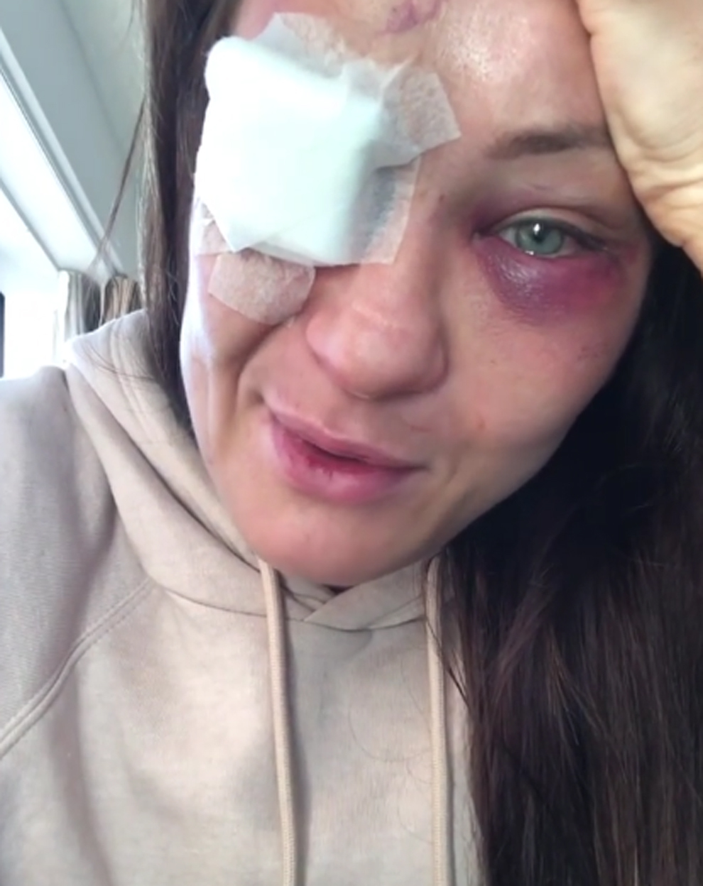 Karolina Kowalkiewicz tras sufrir una fractura en la cuenca del ojo durante su combate contra Xianon Yan 