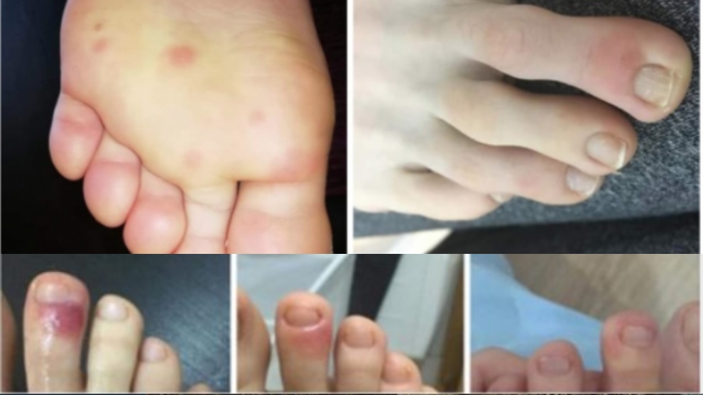 Lesiones en los pies compatibles con el coronavirus.