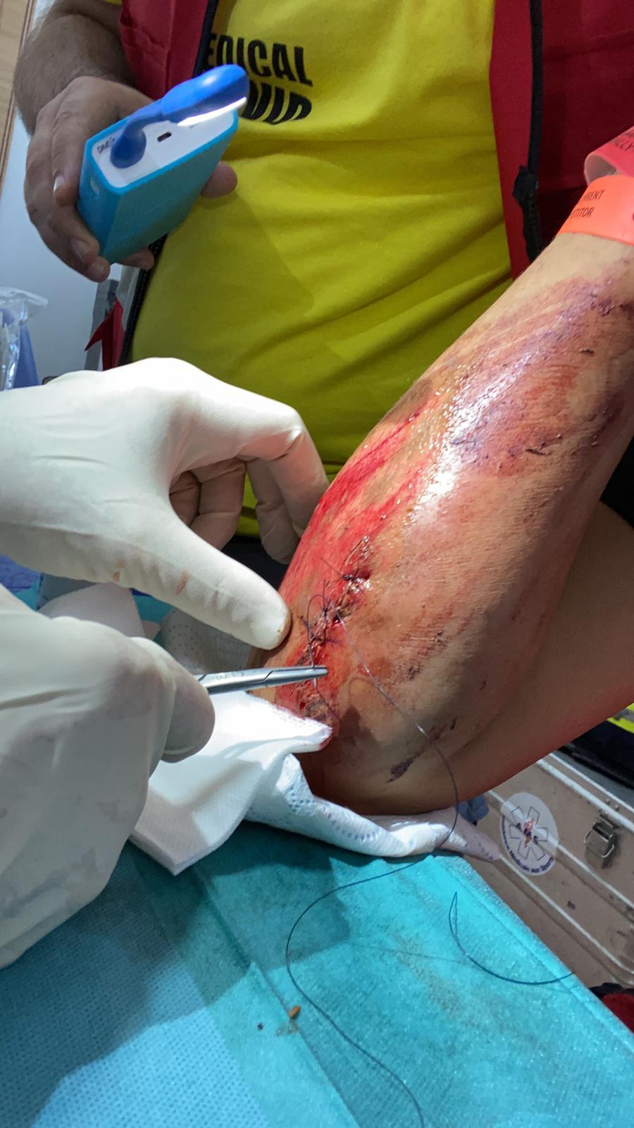 La herida que sufri Laia Sanz y que le ha impedido salir hoy a la primera etapa.
