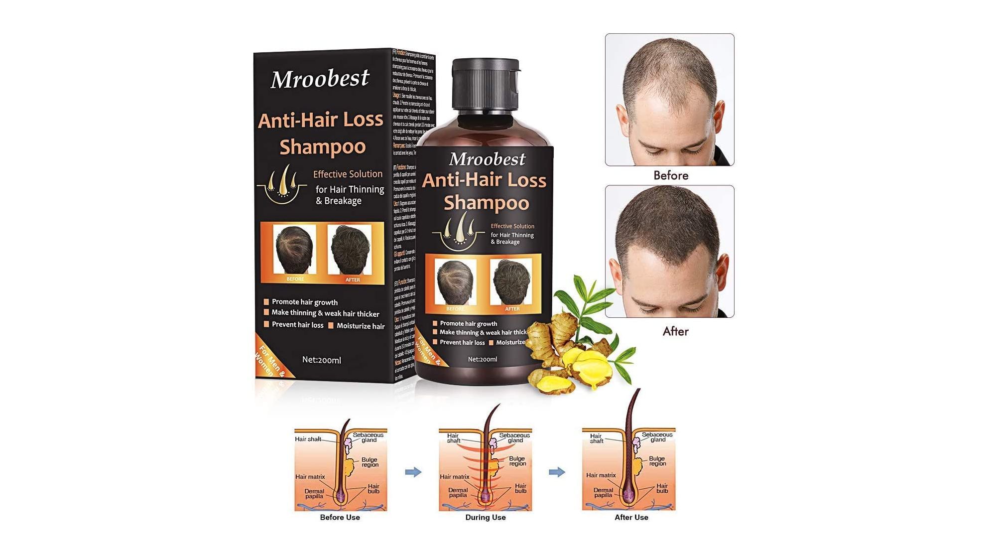 Cmo prevenir la alopecia y evitar la cada del pelo: champs, ampollas y otros productos para el cuidado capilar masculino