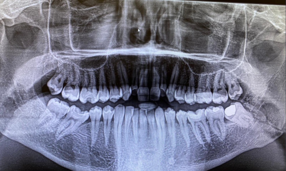 Radiografa realizada anoche de la mandbula de Josh Warrington