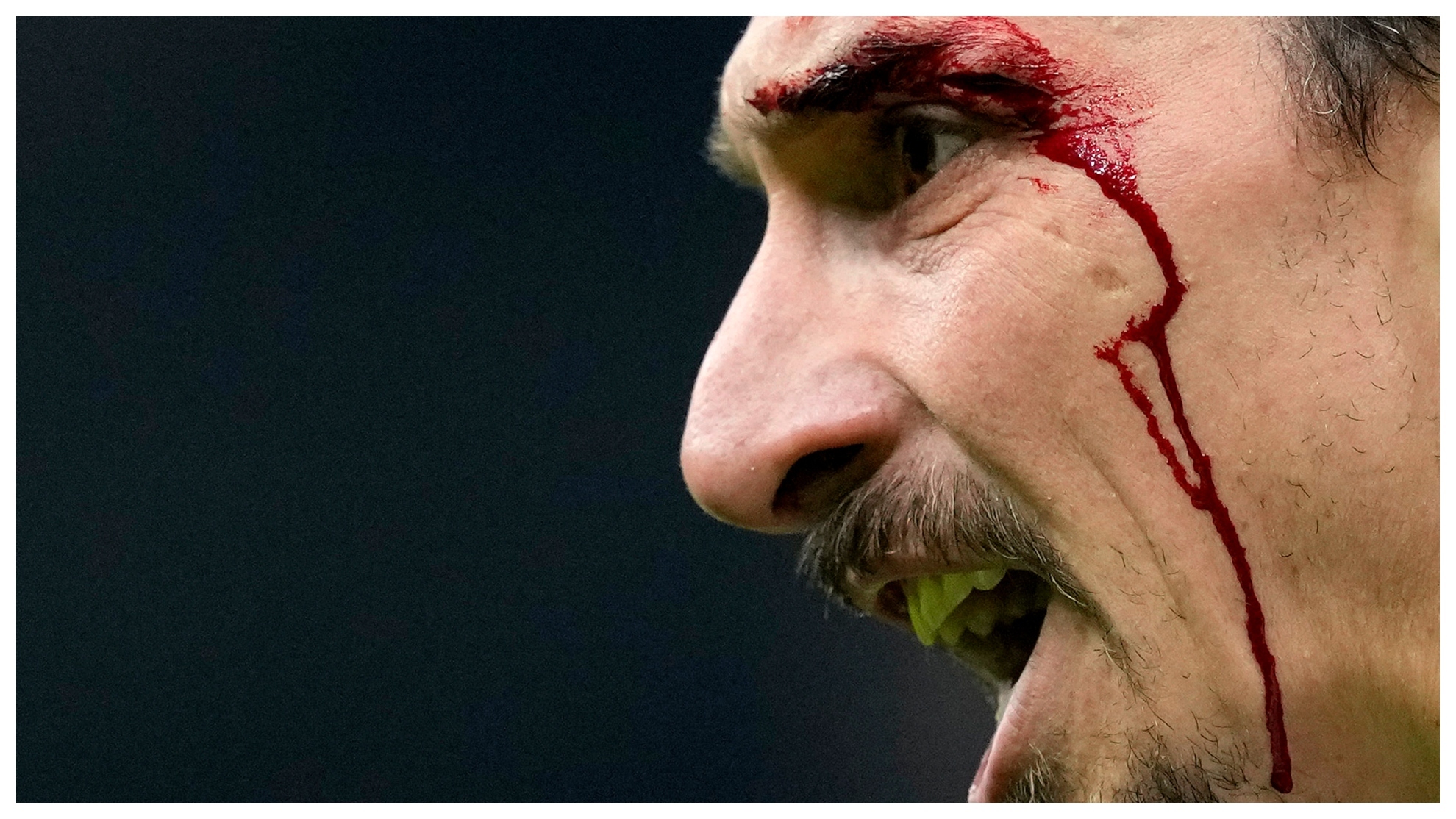 Zlatan Ibrahimovic, ensangrentado tras un choque con Gary Medel.