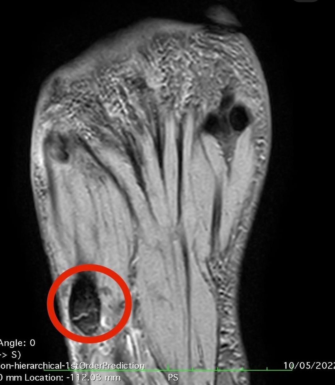 Imagen radiolgica donde se aprecia la fractura sufrida por el nadador