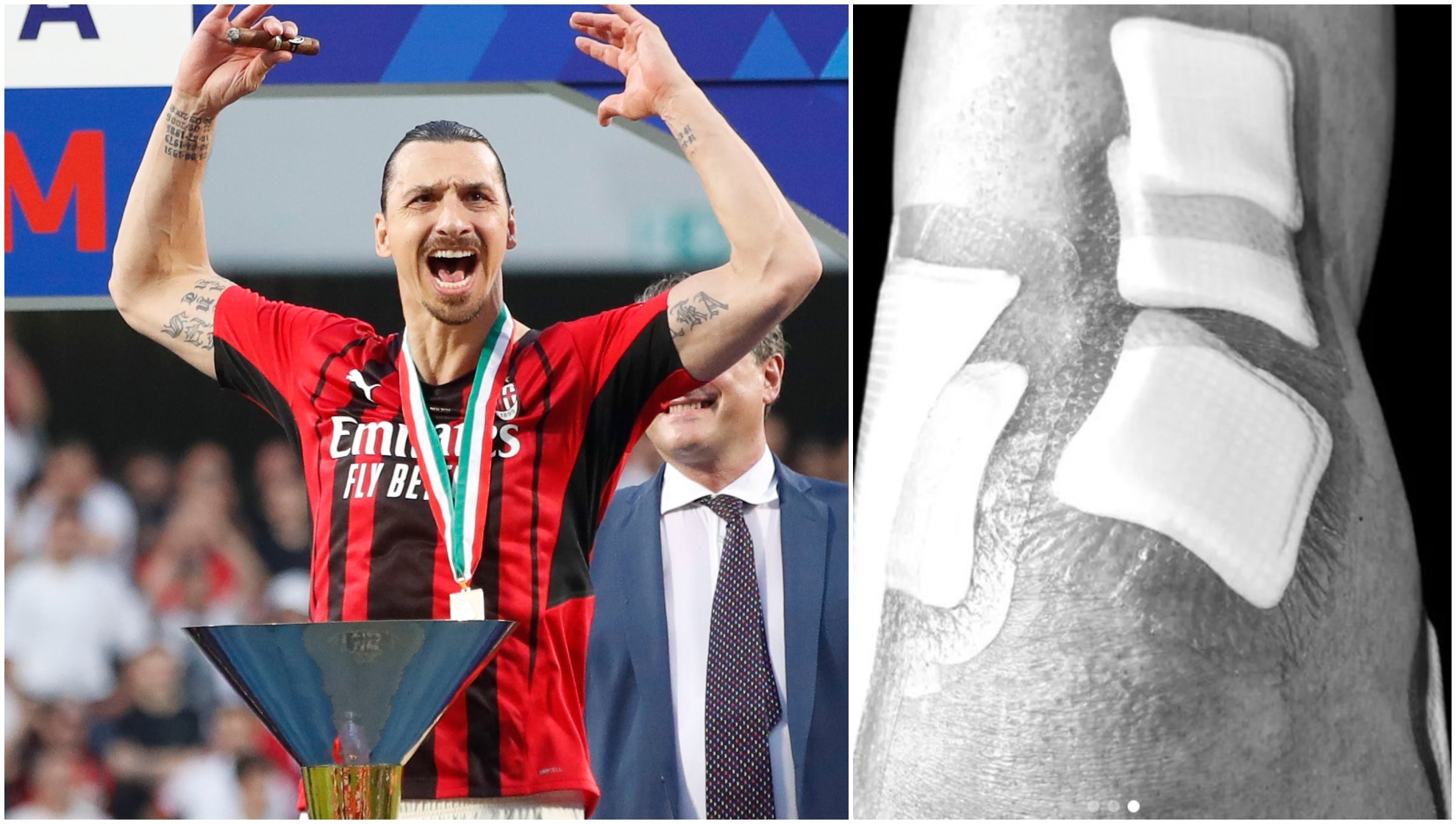 Zlatan Ibrahimovic celebra el Scudetto. Al lado, su rodilla operada.
