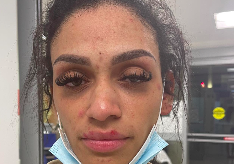 Mychelle Johnson shares photos after alleged abuse from Miles Bridges