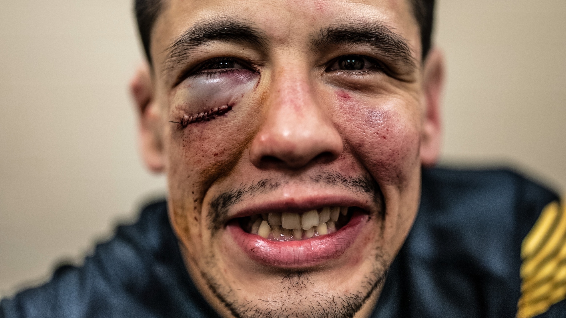 Brandon Moreno quedó con heridas importantes tras vencer a Kara-France en UFC 277.