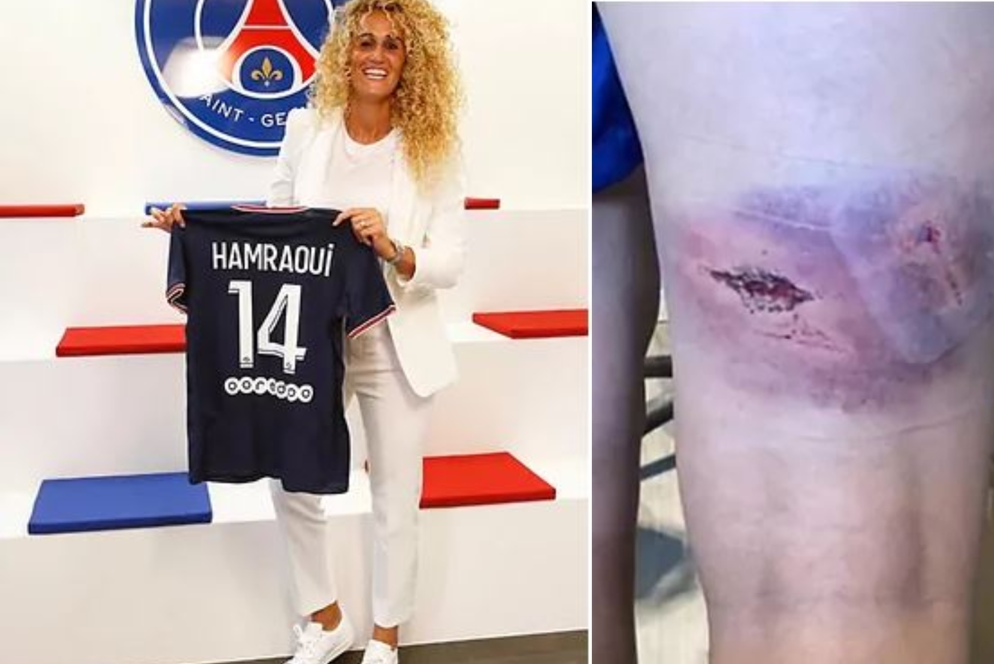 Un montaje con una imagen de Kheira Hamraoui y otra de su pierna tras el ataque.