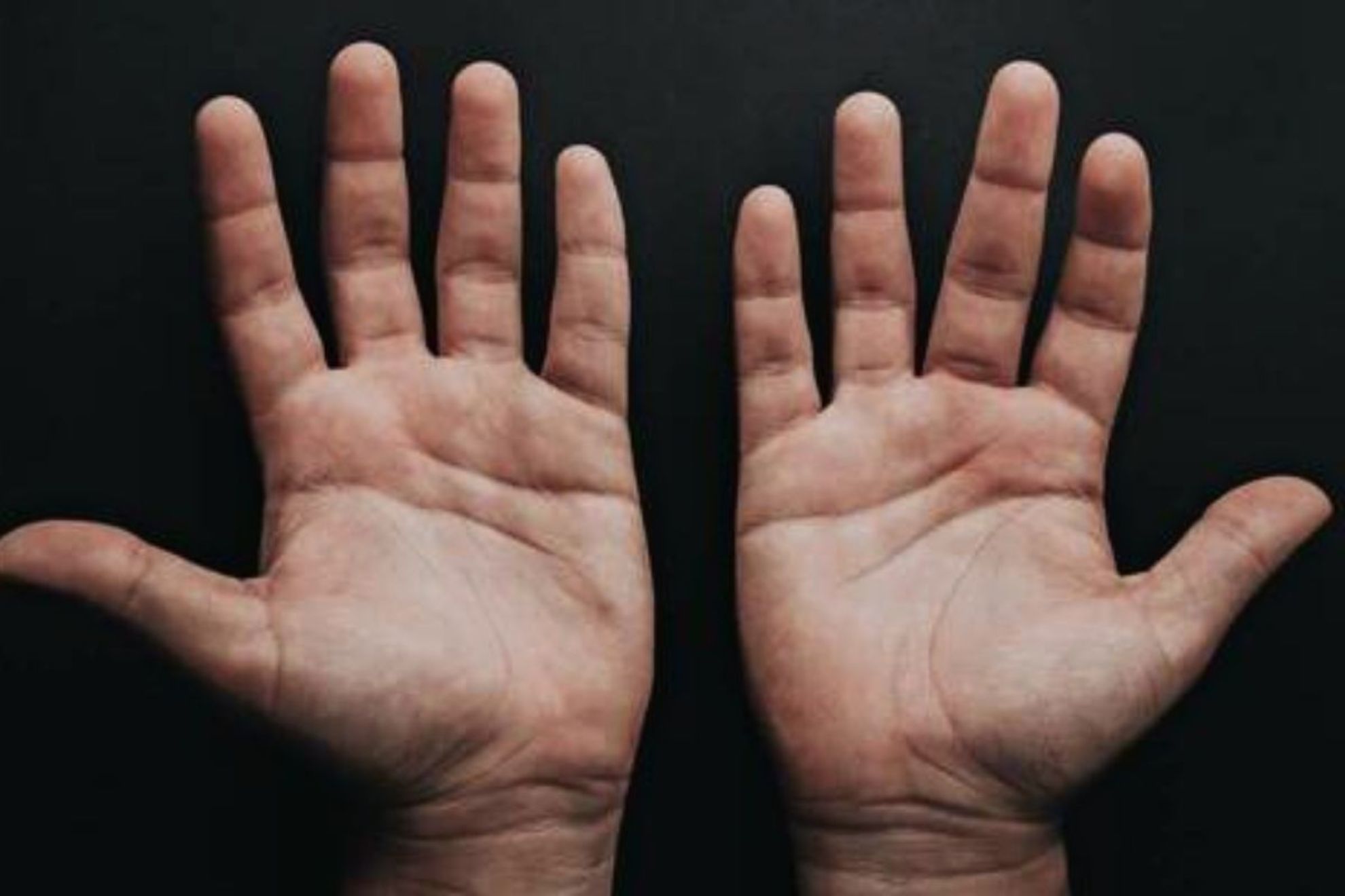 Un nuevo estudio revela que el tamaño de los dedos podría indicar la gravedad del Covid-19