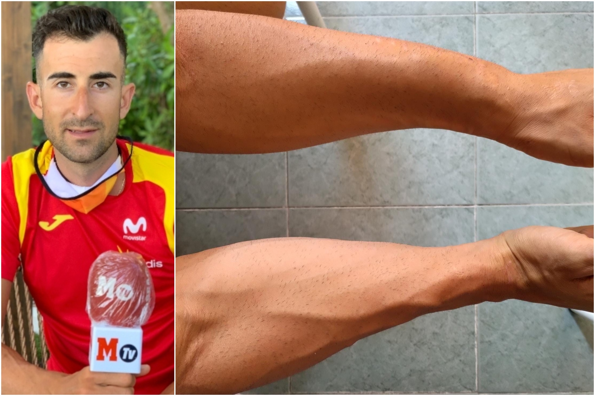Diego Rubio atendiendo a MARCA en Altea y una imagen de sus brazos tras la operación