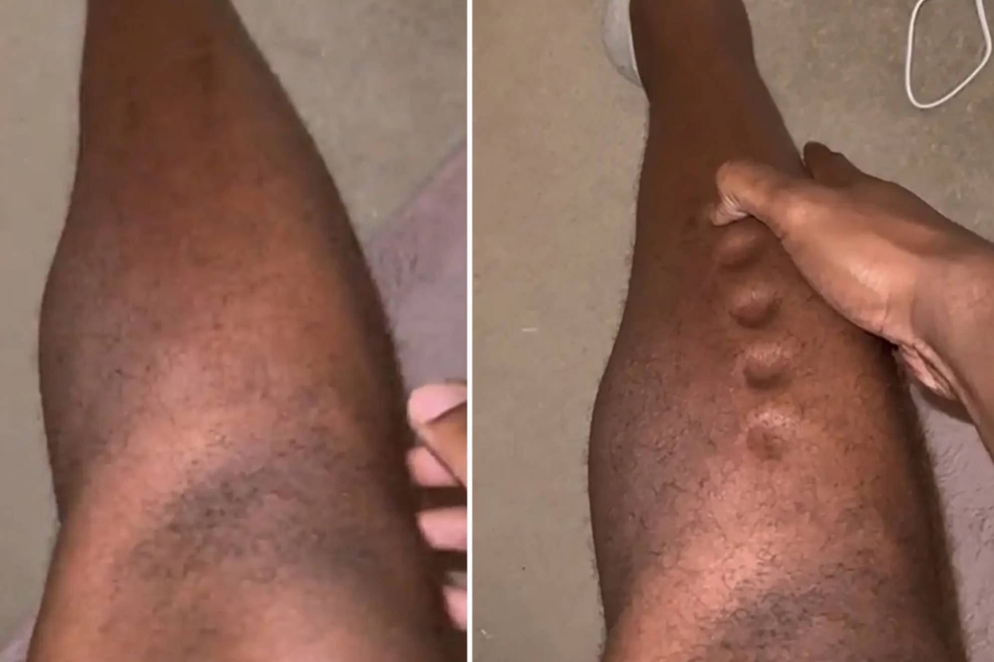 El "asqueroso" vídeo viral de un atleta olímpico: se le forman "agujeros locos" en la pierna al apretarse