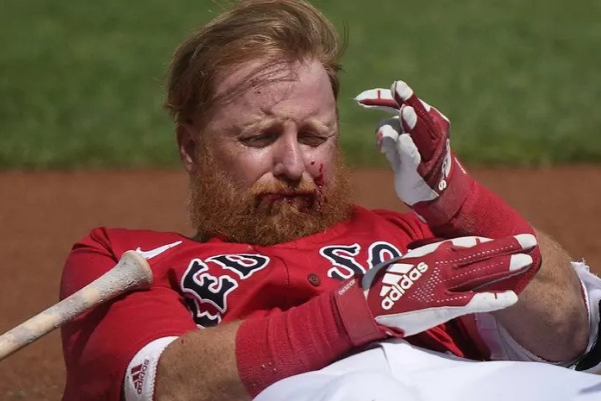 Justin Turner gets hit in the face by a pitch and is taken to hospital