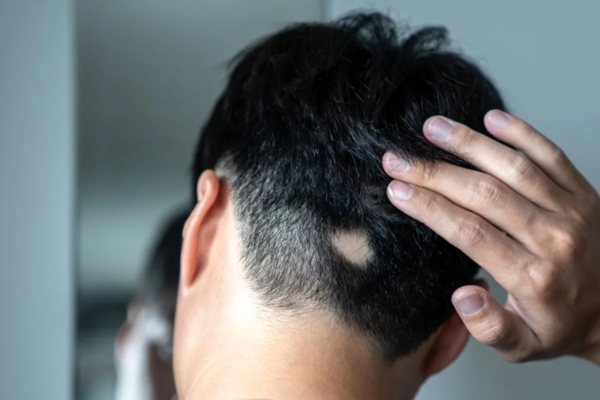 Alopecia areata o parches redondos de calvicie: causas y tratamientos