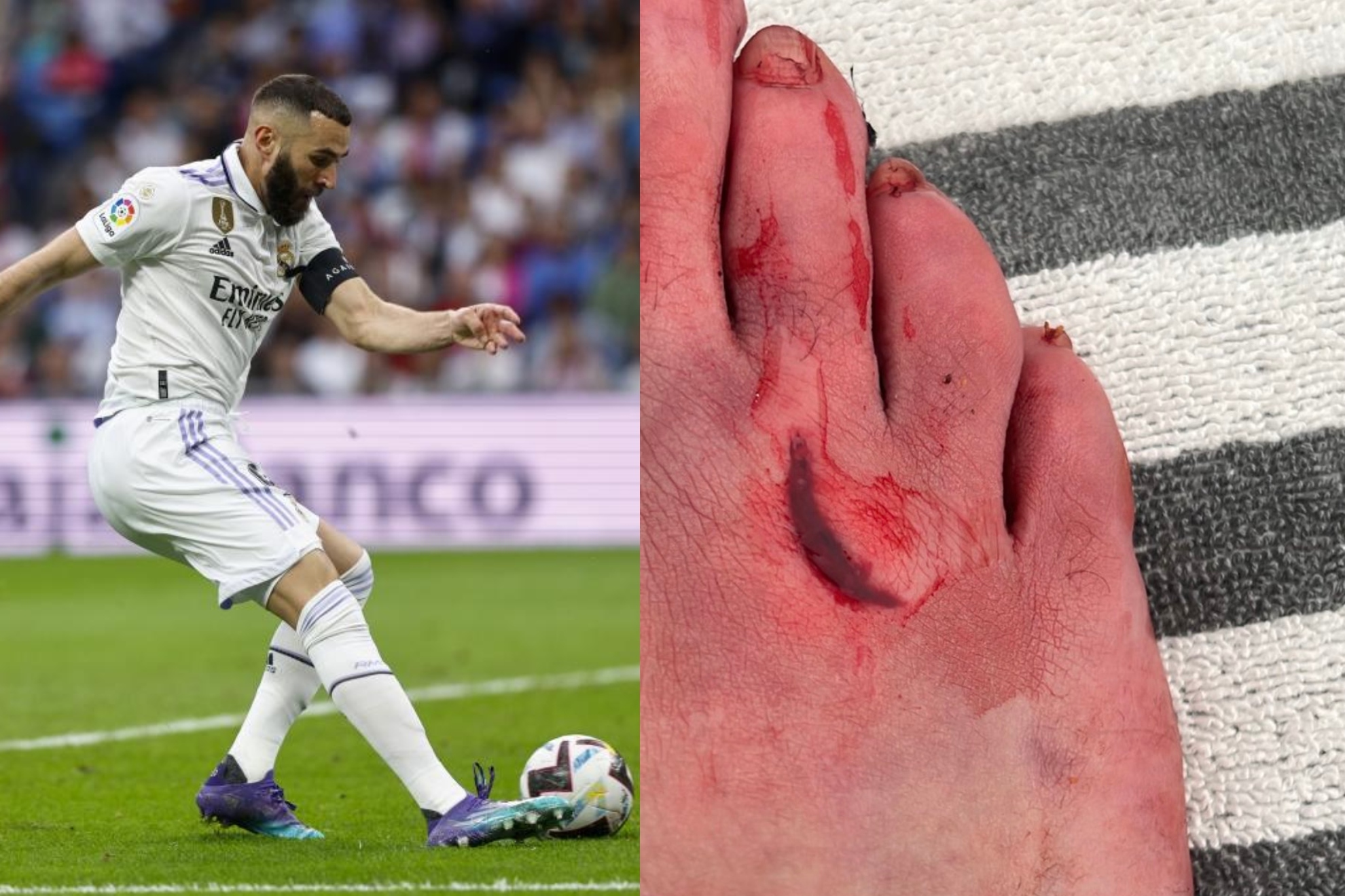 La herida de Karim Benzema