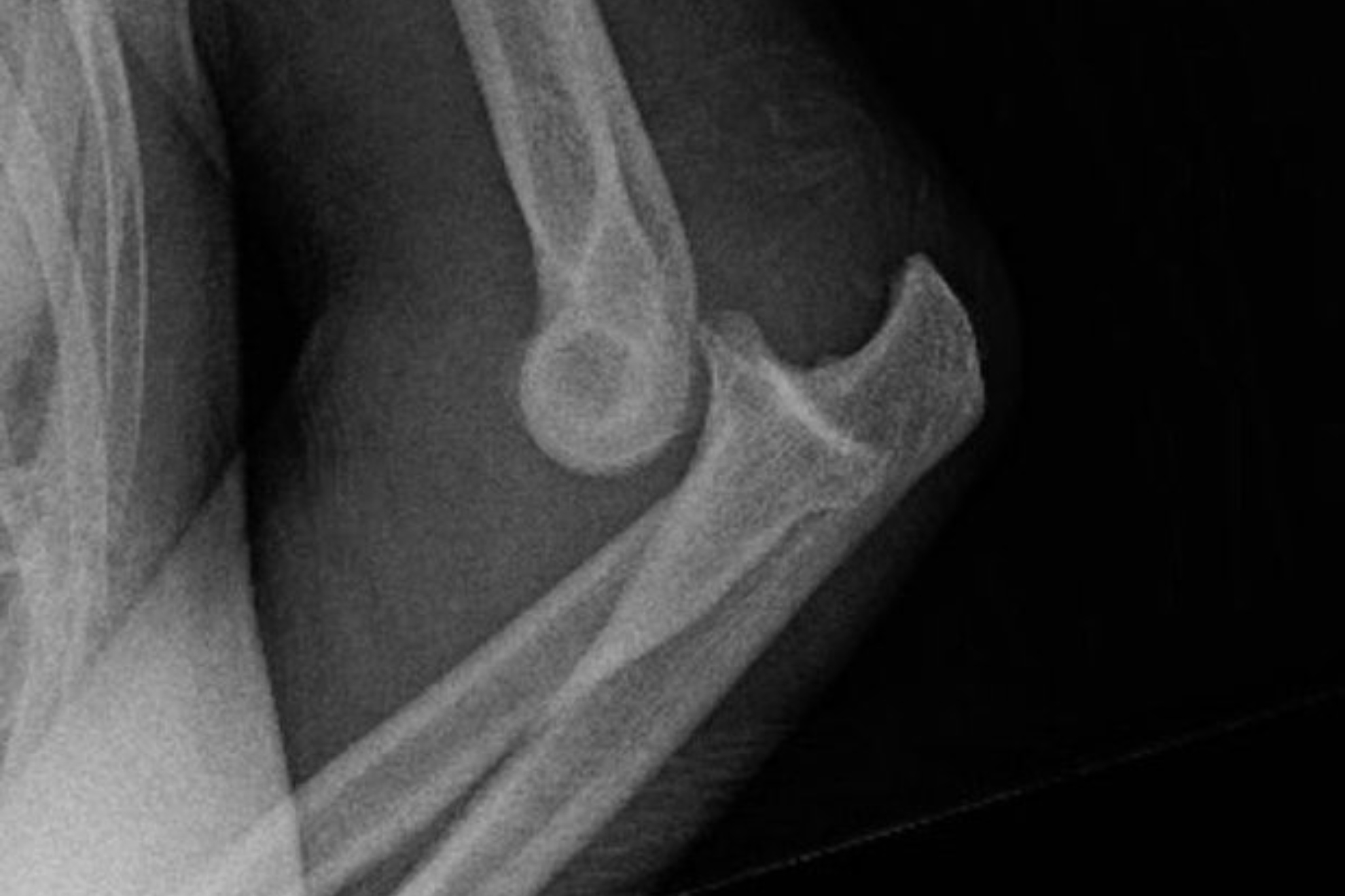 Dana White shares brutal elbow injury X-Ray from Istela Nunes fight