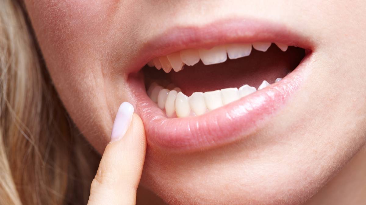 Lo que un herpes labial puede estar dicindote: causas y sntomas