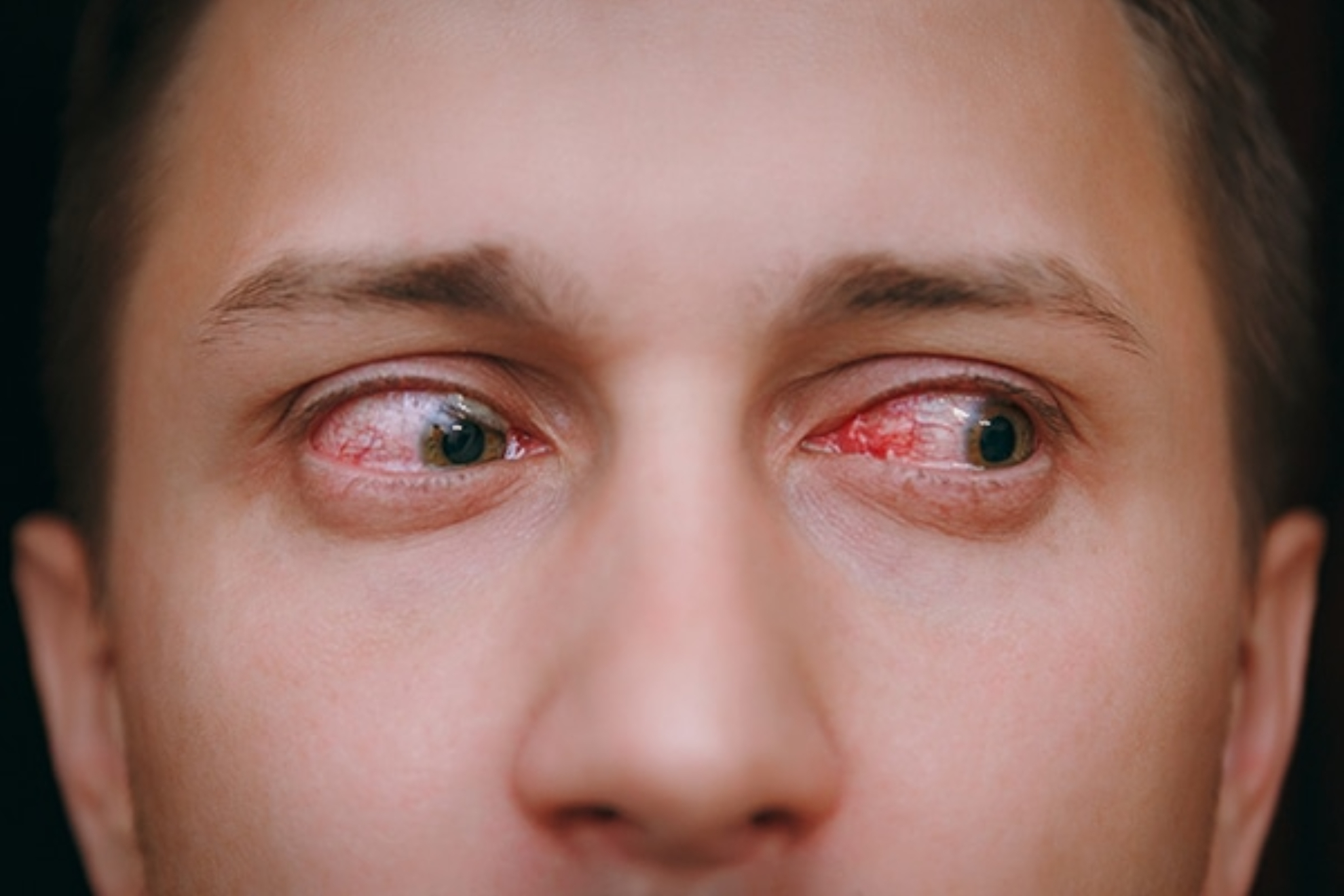 Conjuntivitis: qu es, sntomas, causas y cmo cuidar tus ojos