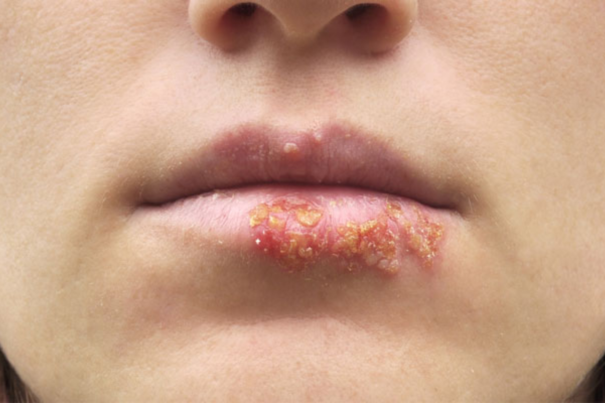 Por qu me salen herpes labiales y cmo prevenirlas?