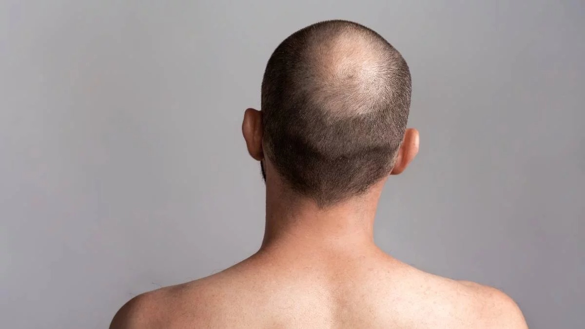 Trasplante de pelo largo: las 5 ventajas de esta técnica contra la calvicie
