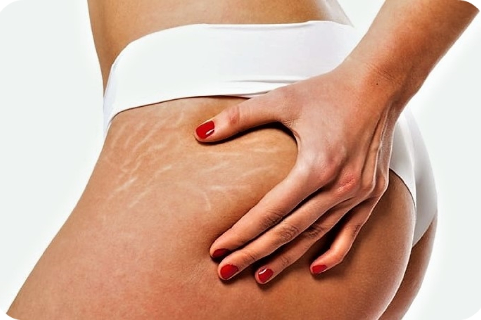 Por qu aparecen las estras en la piel y cmo podemos prevenirlas?