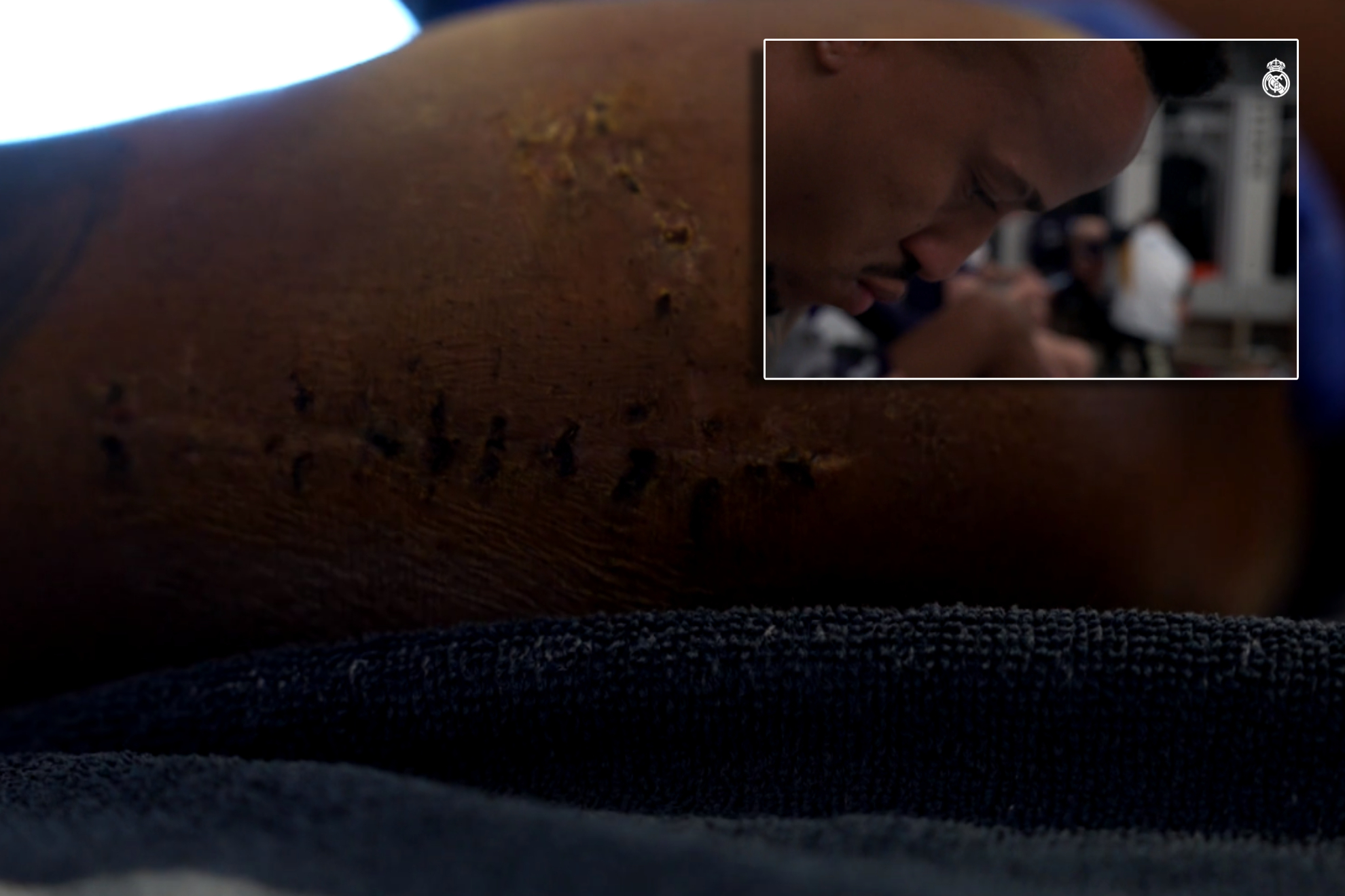 Militao muestra por primera vez su terrible cicatriz: So cinco veces con mi regreso