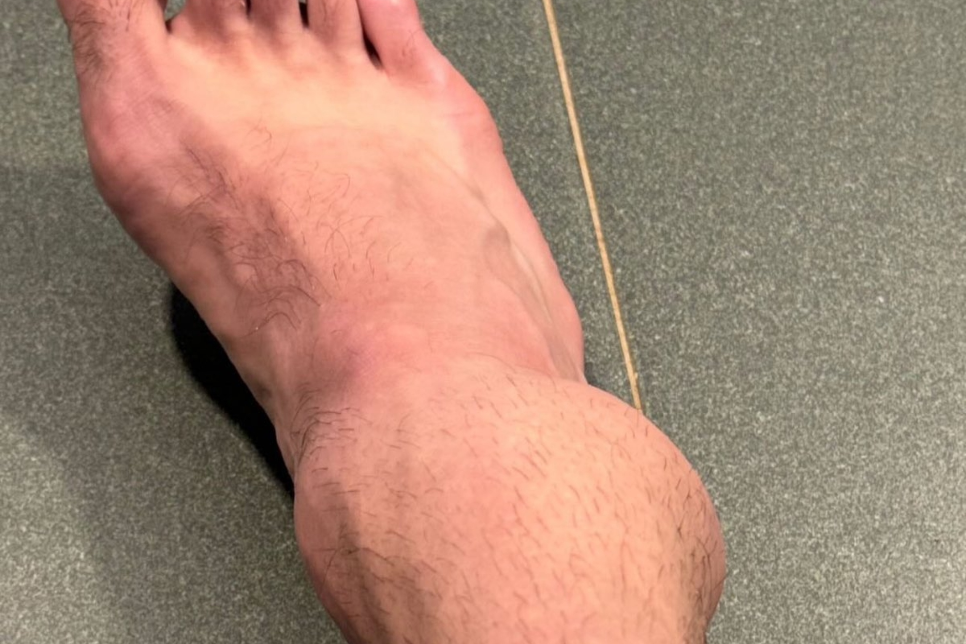Este es el pie de Cauzaux tras la torcedura de tobillo de ayer en Barcelona