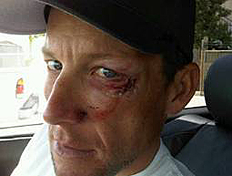 La cara de Armstrong sufre los efectos de una aparatosa cada