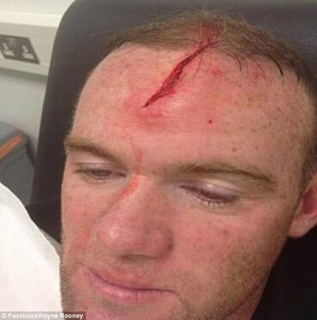Wayne Rooney ensea su brecha gigante en la frente
