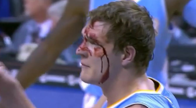 Noche sangrienta en la NBA: triple racin de palos a Mozgov y corte en el ojo