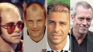 Actores, cantantes, deportistas... Qu famosos se han hecho un trasplante de pelo?
